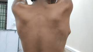 Osteochondroma Scapula  Very Interesting Case Dr Sai Chandra MBBS DNB Ortho [upl. by Yerffej]