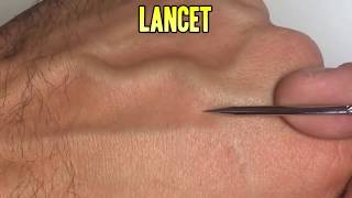 Ingrown Whiteheads Folliculitis amp Pimple Popping 101 [upl. by Roane]