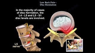 Low Back Pain  Disc Herniation  Everything You Need To Know  Dr Nabil Ebraheim [upl. by Fabrianna]