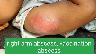 vaccination abscess [upl. by Pandolfi]