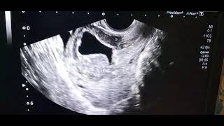 Failed Pregnancy with chorionic bump [upl. by Anitsahs]