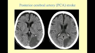 Stroke Syndromes older version with sound  CRASH Medical Review Series [upl. by Neibart694]