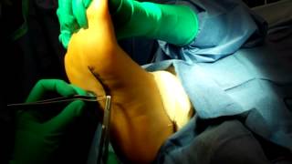 Excision of Plantar Fibroma Part 3 [upl. by Sido]