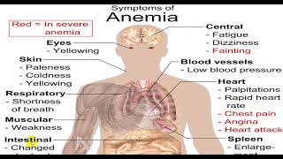 MICROCYTIC HYPOCHROMIC ANEMIA 4TH YR [upl. by Vera111]