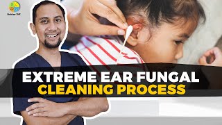 EXTREME EAR FUNGAL CLEANING PROCESS [upl. by Amalee]