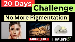 20 Days Challenge to remove Pigmentation  आसान तरीक़ा झाईयाँ मिटाने का [upl. by Eelinnej]