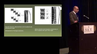 Spinal Cord Ischemia with Endovascular Treatment of Thoracoabdominal Aortic Aneurysms [upl. by Emmer]