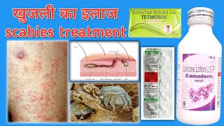 Gamaderm Lotion 🧴 Uses in Hindi खुजली का इलाज Scabies Treatment in Hindi [upl. by Ahso]