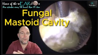 FUNGAL MASTOID CAVITY 237 ear earwax earwaxremoval earcleaning fungal asmr fyp mastoid [upl. by Anu]