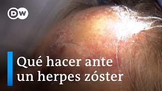 Primero varicela luego herpes zóster [upl. by Errot]