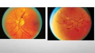 Retinopatía Diabética no prolifera y Proliferativa y coriorretinopatía serosa Central [upl. by Aicylla156]