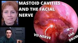 Mastoid Cavity Ear Surgery amp The Facial Nerve Explained [upl. by Aciruam]