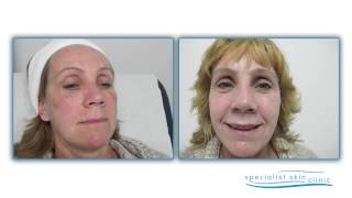 Specialist Skin Clinic Patient Testimonials [upl. by Eseilanna]