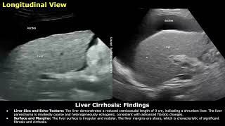 Liver Cirrhosis With Portal Hypertension Ascites amp Splenomegaly Ultrasound Report Example  USG [upl. by Korfonta311]