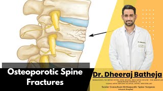 Transform Your Understanding of Osteoporotic Spine Fractures with Dr Dheeraj Batheja [upl. by Fritzie577]