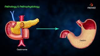 ZollingerEllison syndrome ZES  Animated lecture usmle step 1 pathology  Dr Bhanu prakash [upl. by Tioneb]