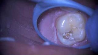 Removal of a Failing Dental Sealant [upl. by Nnyleak427]