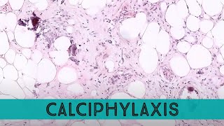 Calciphylaxis under the microscope complication of ESRD chronic kidney disease pathology dermpath [upl. by Alrich]