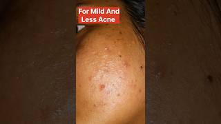 how to treat acne pimples azelaic acid or glocin gel which is better acnetreatment azelaicacid [upl. by Boatwright]