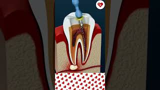 What are DENTISTS doing to your teeth shortsfeed shorts dentist animation [upl. by Enohsal]