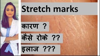 स्ट्रेच मार्क्स का ईलाज  Stretch marks in Hindi  त्वचा के डॉक्टर  डॉ आँचल पंत [upl. by Navar]