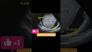 Ascites And Pleural Effusion abdomen usg ascites pleuraleffusion [upl. by Basir785]