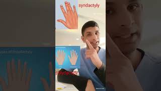 Syndactyly and polydactyly short viralvideo viralstatus shortvideo motivation [upl. by Assillim]