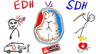 Extra duralEpidural Hematoma Vs Subdural Hematoma for Usmle Plab FCPS Medicine [upl. by Haimerej]