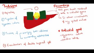 Hydatid disease of liver [upl. by Wash]