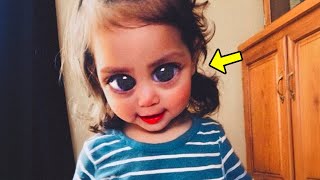 Remember The Baby Born With Huge Eyes You Wont Believe How She Looks Now [upl. by Ahsiloc]