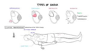 Approach to Shock  types hypovolemic cardiogenic distributive anaphylaxis pathology treatment [upl. by Briant]