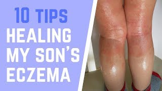 How I am Healing my Sons Eczema Naturally  10 Easy Tips  Natural Remedies [upl. by Eirrak]