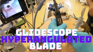 How to Intubate your patient with a GlideScope Hyperangulated Blade [upl. by Yduj]