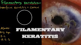 Filamentary Keratitis  Ophthalmology [upl. by Arinayed]