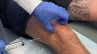 KNEE Intraarticular injection of Local Anaesthetic and Steroid [upl. by Carree]