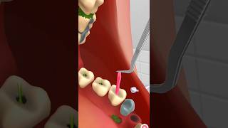 teeth treatment  treatment by animation animationvideo kidsvideo drgame [upl. by Aninotna]