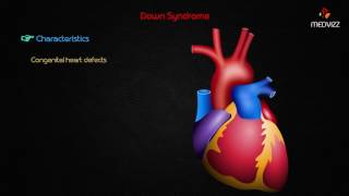 Down Syndrome  Usmle Step 1 lecture [upl. by Inihor91]