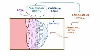 Membranous Glomerulonephritis  Renal Pathology  Osmosis [upl. by Catherine]