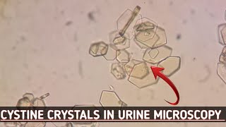 Cystine crystals seen in urine microscopyBest crystals view in microscopeUrine routine examination [upl. by Cyndi]