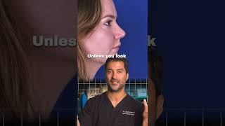 Rhinoplasty Recovery What to Expect rhinoplastyhealing rhinoplastyrecoverynosesurgery [upl. by Allisan]