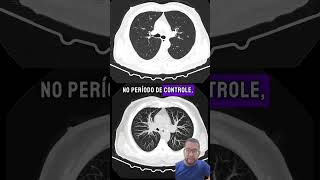 Tc de tórax para avaliação de nódulos pulmonares [upl. by Ardena]