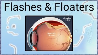 Flashes amp Floaters  A Sign of Retinal Detachment [upl. by Ocir]