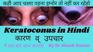 keratoconus in hindi  c3r keratoconus treatment common eye problems  What is keratoconus [upl. by Nelle]