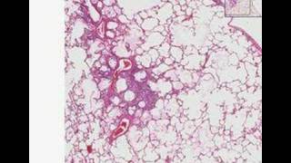 Histopathology LungEmphysema [upl. by Remot436]