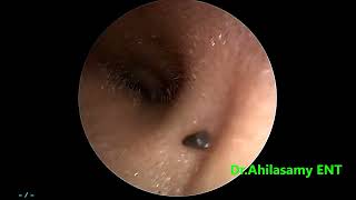 Multiple Vegetable Foreign bodies R Ear endoscopic Removal in a 7 yrs old boy [upl. by Akiner]