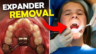 Getting Palatal Expander OFF… What happens when you get your Expander Off  McKinney Orthodontist [upl. by Doowron405]