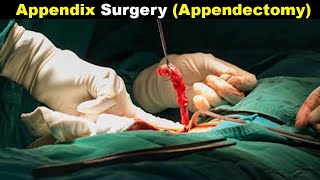 How Does Appendectomy Works  Appendicitis treatment UrduHindi [upl. by Elum961]