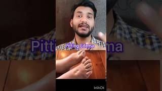 Pitting edema shorts [upl. by Anircam]