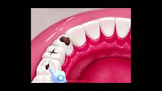 Ultimate Guide to Teeth Cavity Treatment  BeautyByte Animations [upl. by Ellimaj]