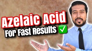 Azelaic Acid for Melasma  How to Use Azelaic Acid for SUCCESS 🏆 [upl. by Ecirtaed315]